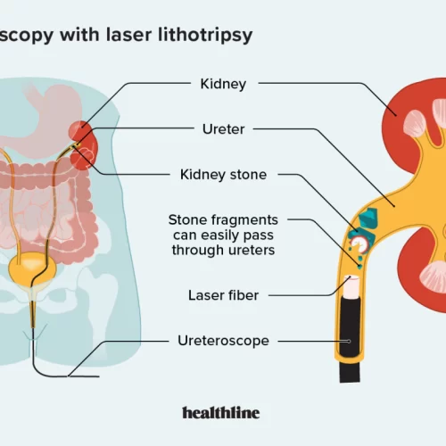 2556967-Ureteroscopy-with-Laser-Lithotripsy_1296x885body