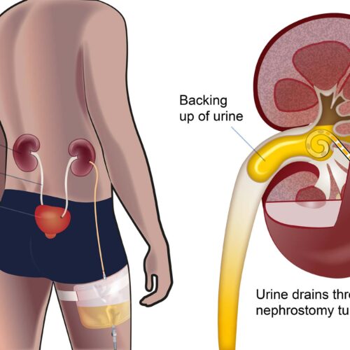 Kidney-location-and-NUK-bag-on-thigh
